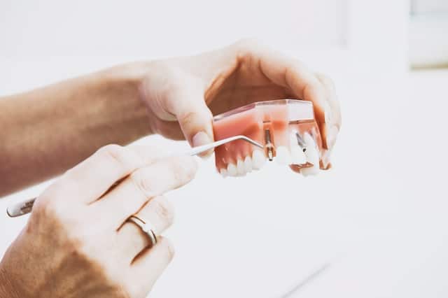 Cena implantu zęba Kraków – czy istnieją bezpieczne opcje finansowania zabiegu?